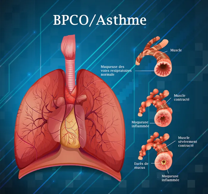 Asthme BPCO